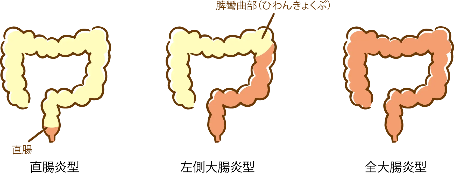 炎症の範囲による潰瘍性大腸炎の分類