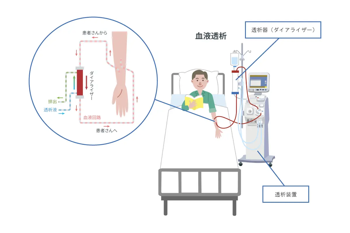 血液透析の仕組み